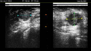 Проведение УЗИ-измерений