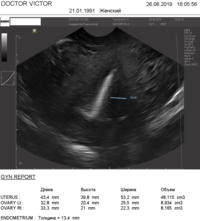 УЗИ аппарат для гинекологии